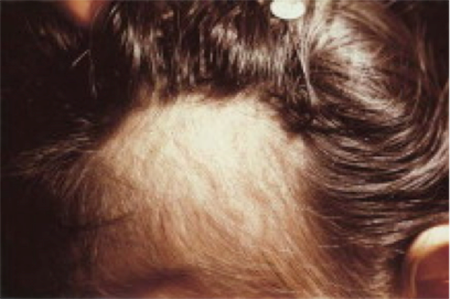 Public_Diseases_Hair-Loss_Symptoms-Trichotillomania