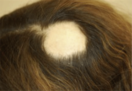 Public_Diseases_Hair-Loss_Symptoms-alopecia