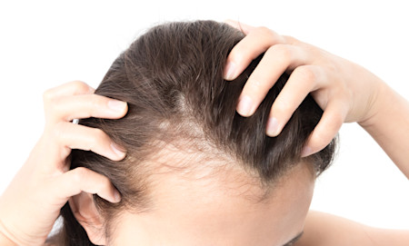 Public_Diseases_Hair-Loss_Symptoms-female-hairline