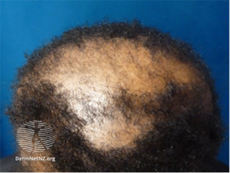 Public_Diseases_Hair-Loss_Symptoms-man-bald
