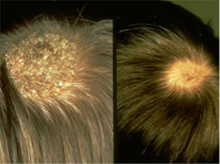 Public_Diseases_Hair-Loss_Symptoms-ringworm