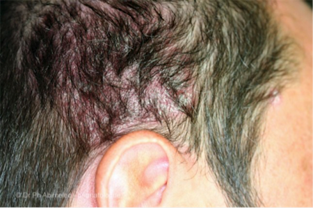 Public_Diseases_Hair-Loss_Symptoms-scalo-psoriasis