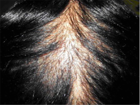 Public_Diseases_Hair-Loss_Symptoms-scarring-alopecia