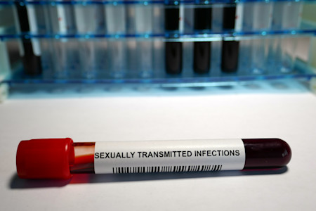 Public_Diseases_Hair-Loss_Symptoms-sexually-transmitted